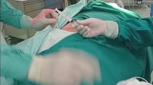 Радиочастотная денервация фасет суставов (РЧА)