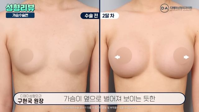 모티바 가슴성형, 자산이 없으면 가슴수술 티날까? | 디에이성형외과 смотреть онлайн