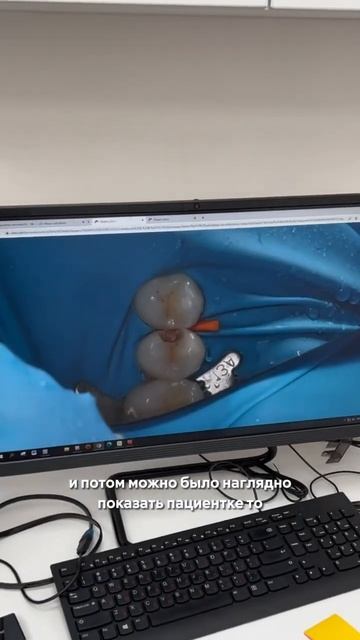 Лечение кариеса | Наша стоматология СПб смотреть онлайн