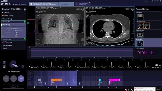 How to scan coronary arteries on SIEMENS go.Top & ALL - تصوير شرايين القلب بواسطه جهاز سيمنس جو توب смотреть онлайн