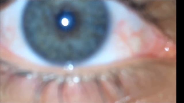 Permanent eye color change with laser (2G) смотреть онлайн