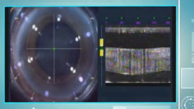 Copy of Femto Laser Cataract Surgery смотреть онлайн