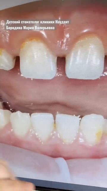 Почему образуется налёт даже при регулярной чистке зубов? #shorts смотреть онлайн