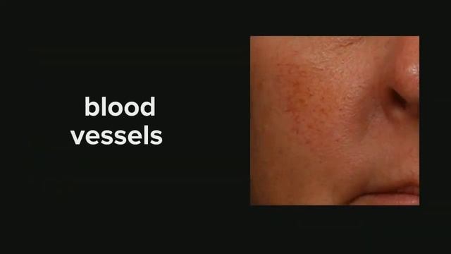 VBeam Laser at Dermatology & Laser of Del Mar смотреть онлайн