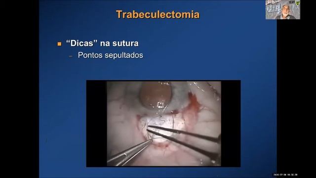 Oftalmologia - Ainda Trabeculectomia? смотреть онлайн
