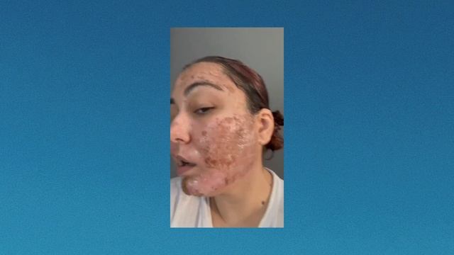 Healing Process of C02 and PRF Treatment смотреть онлайн