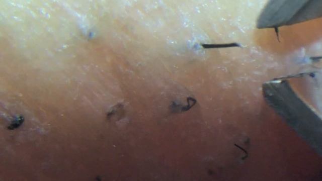 埋没毛抜き　pulling Out Deep Hair / Ingrown Hair