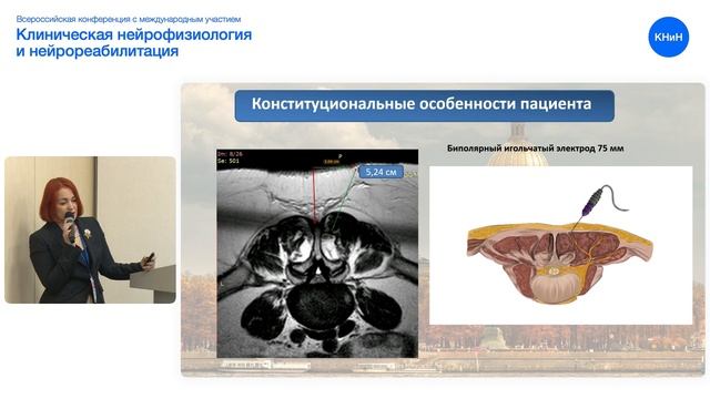 Миография параспинальных мышц в диагностике радикулопатии. Селиверстова Е. Г. смотреть онлайн