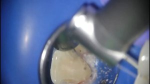 Лечение множественного кариес передних зубов