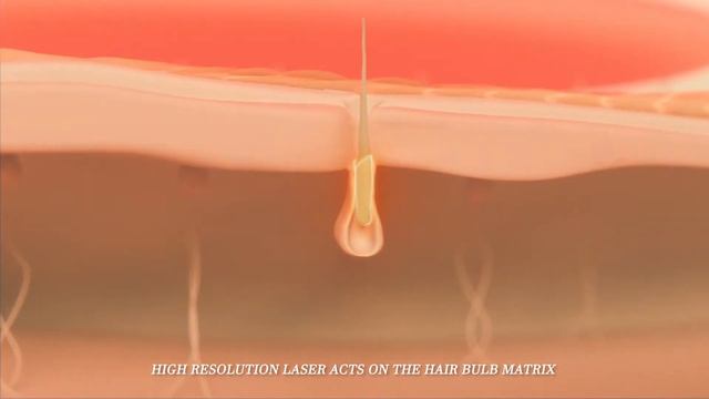 EpilPlus - 808nm High Resoulution Epilation Laser смотреть онлайн