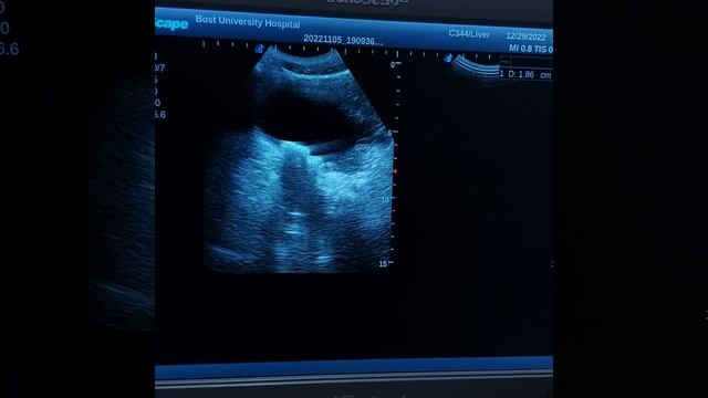 Right side pelvic crossed fussed renal ectopia & urinary bladder stone смотреть онлайн
