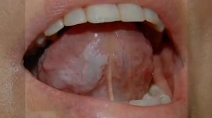 Лейкоплакия (полости рта)