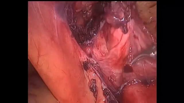 Laparoscopic (TAPP) inguinal hernia repair Лапароскопическая герниопластика ТАРР - 15 смотреть онлайн