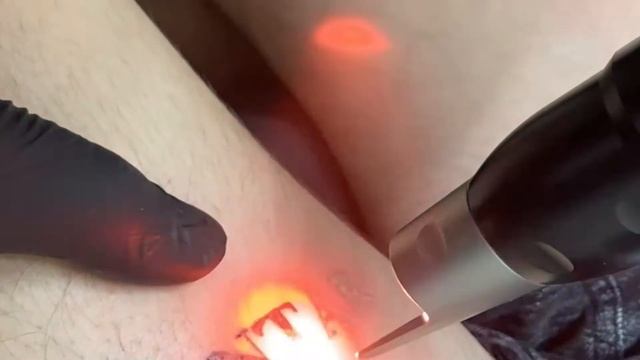 Frosting a tattoo with Picosure Laser Tattoo Removal смотреть онлайн