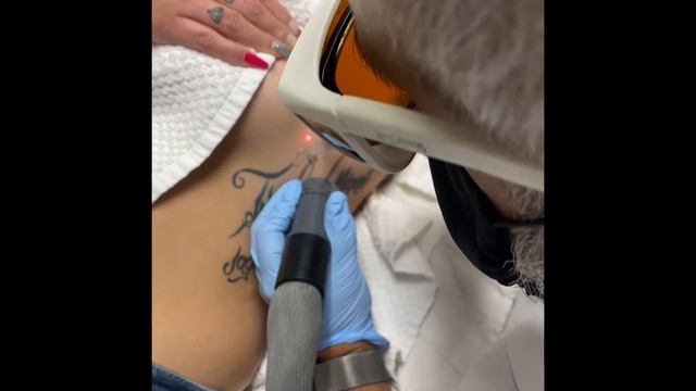 Laser tattoo removal смотреть онлайн