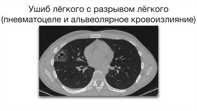 Матовое стекло от морфологии к лучевой диагностике смотреть онлайн