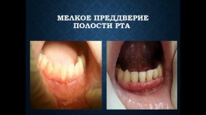 Аномалии слизистой оболочки рта