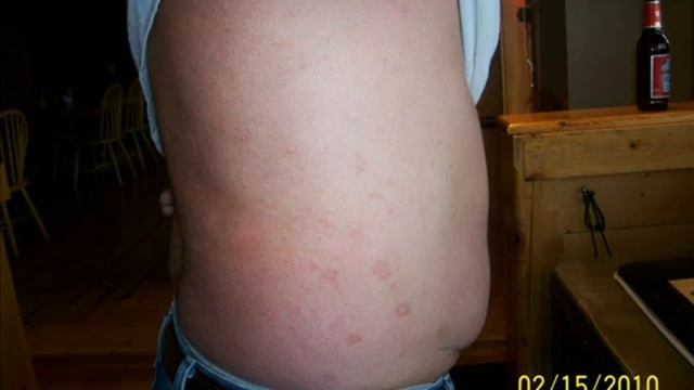 Лечение псориаза натуральными напитками SISEL смотреть онлайн