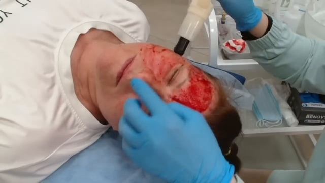 Онлайн-практикум по капилляротерапии лица (доступ к слайдам и чату в описании) смотреть онлайн