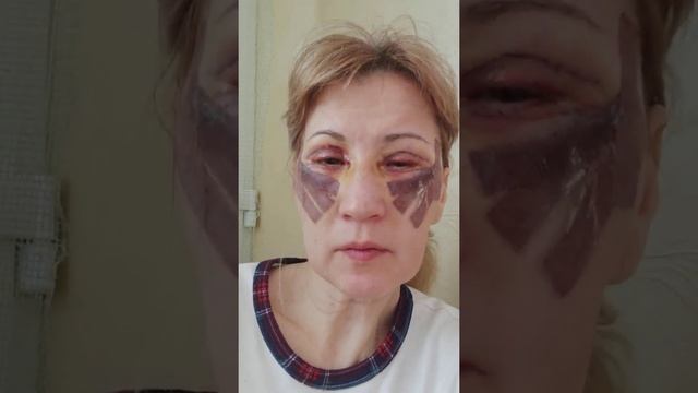 # Блефаропластика или операция век. Восстановление 5 день часть 2 из 186 дней. Надо ли пить Кетанол смотреть онлайн
