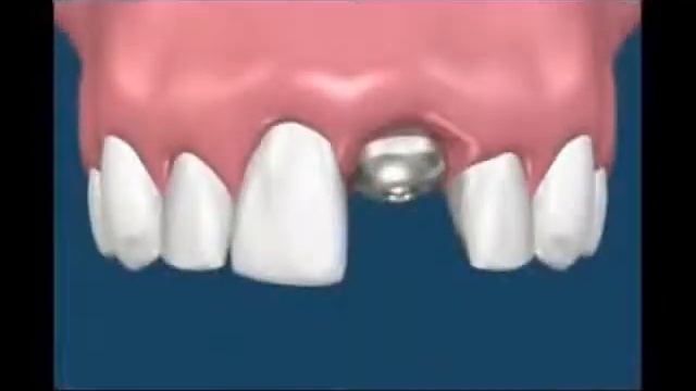 Имплант.wmv смотреть онлайн