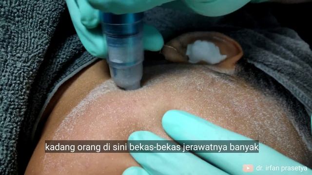 Microdermabrasi (Diamond Peeling) | On The Spot Natasha Skincare Sidoarjo смотреть онлайн