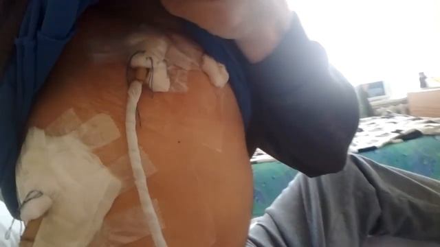 Лопнуло лёгкое