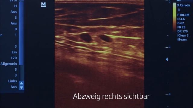biolitec medical laser: Dr. Dorka wendet die ELVeS® Lasertherapie für die Krampfaderbehandlung an смотреть онлайн