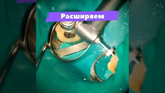 Pulpitis Treatment