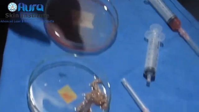 Vitiligo Laser Assisted Surgical Treatment at Aura Skin Institute, Chandigarh, INDIA смотреть онлайн