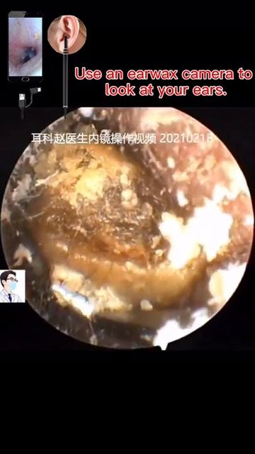 Best Ear Wax Removal & Extraction with Vacuum Remover 真空リムーバーによるにきびの除去と抽出 190 смотреть онлайн