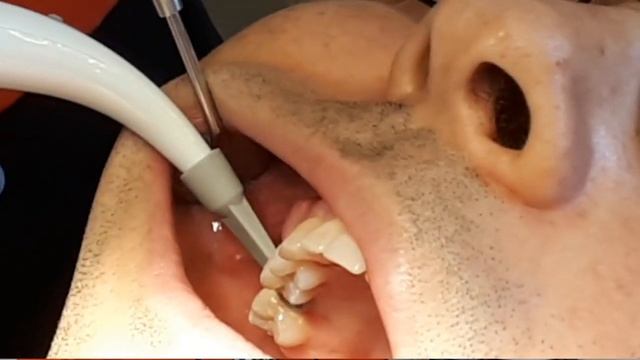 Dr Yoav Averbuch testimonial on Spotter Implant Detector смотреть онлайн