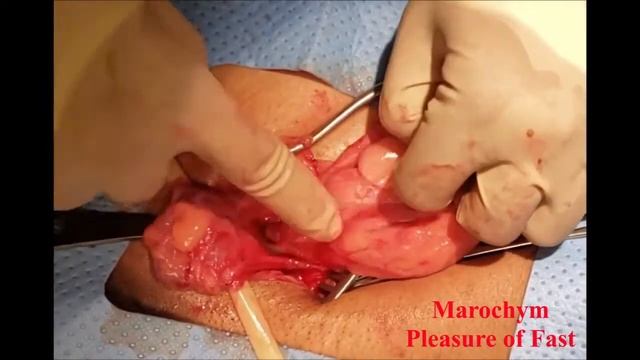 Inguinal or Groin Hernia Repair смотреть онлайн