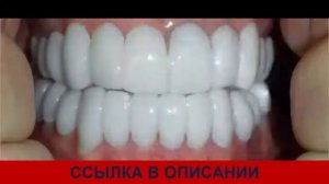 виниры smile как поставить накладные виниры