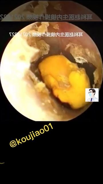 Best Ear Wax Removal & Extraction with Vacuum Remover 真空リムーバーによるにきびの除去と抽出 36 смотреть онлайн
