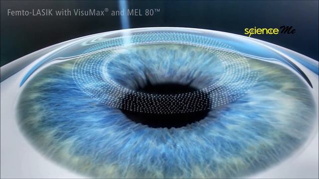 Femto LASIK Eye Surgery - Explained смотреть онлайн