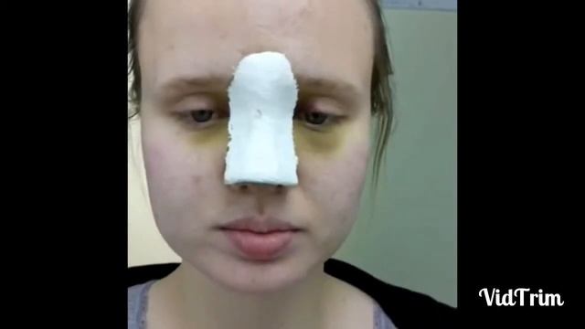 Ринопластика: реабилитация 7 дней после операции, 10 дней после операции. смотреть онлайн