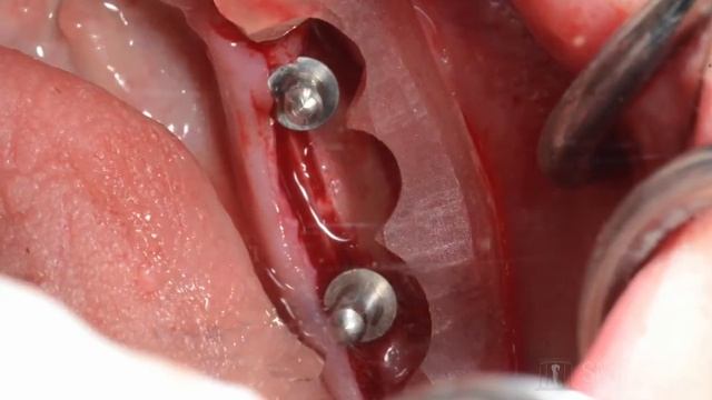 Ridge expansion with Piezo surgery and expansion drills смотреть онлайн