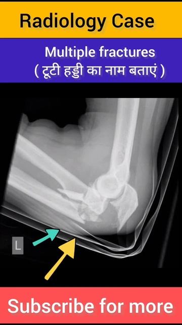 #radiographer #paramedical #question #radiologycase #radiology #carcinoma #cancer #aiims #radio смотреть онлайн