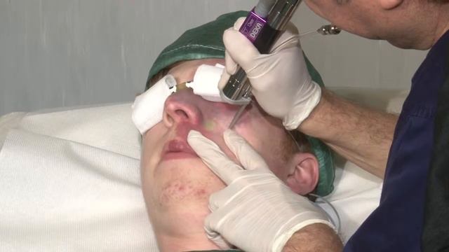 Synchro VasQ: Facial PWS Treatment смотреть онлайн