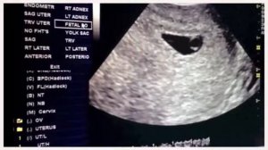 УЗИ на 5 неделе беременности