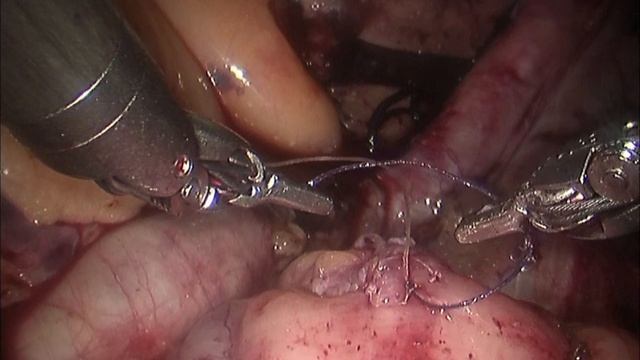 Novel knot tying technique for robot-assisted surgery смотреть онлайн