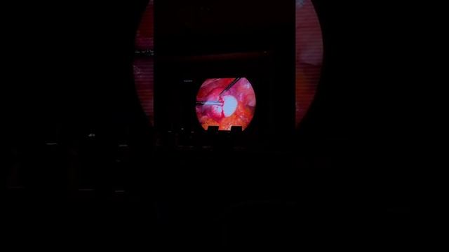 2 эндоскопиялық операция: тератома смотреть онлайн