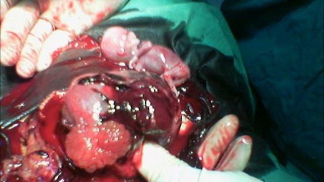 Dr.Khaled Refaie ectopic pregnancy смотреть онлайн