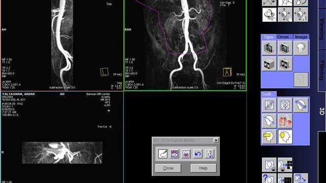 MRI Application training MRA Abd Aorta Angiography #abdominal #aorta #angiography #MRA #MRI #Mrv смотреть онлайн