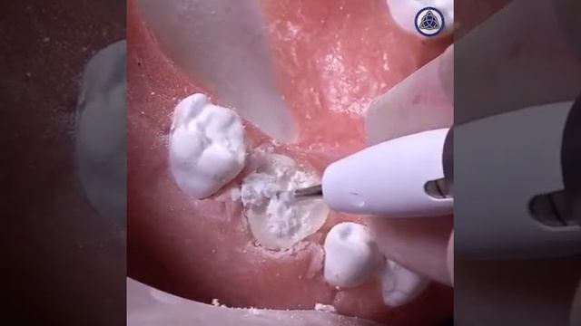 Taking the Mystery Out of Extractions Maxillary First Molars смотреть онлайн