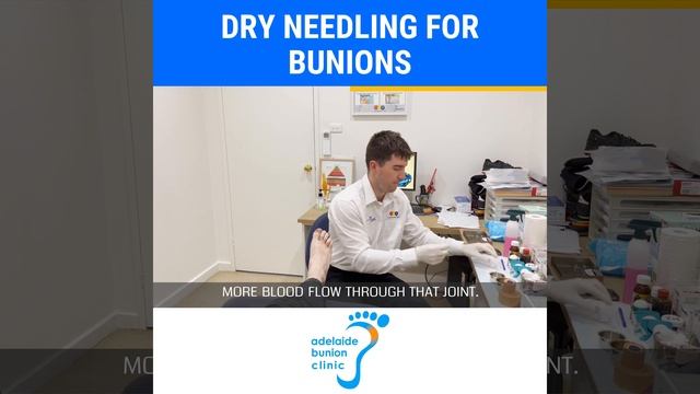 Dry Needling for Bunions смотреть онлайн