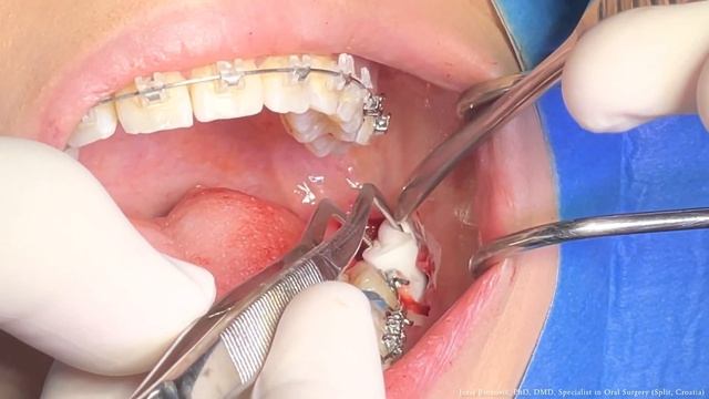 Parasorb Cone смотреть онлайн