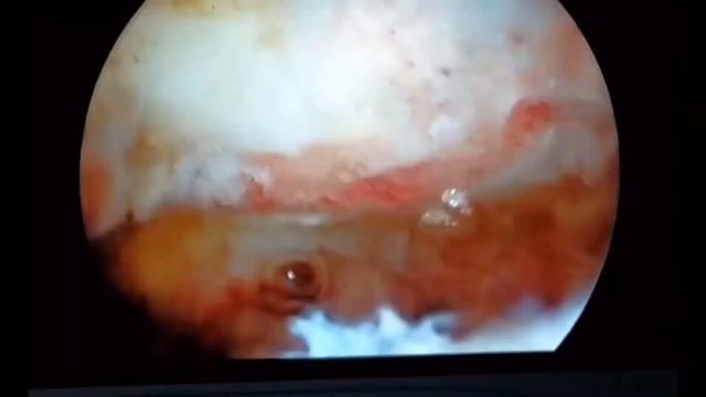 Arthroscopic Rotator cuff repair and Subacromial decompression Shoulder Surgery in jaipur смотреть онлайн