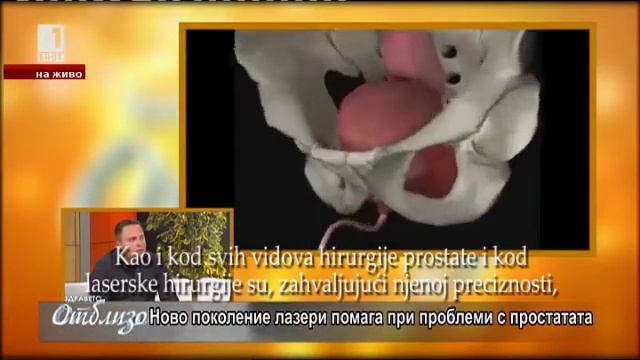 Tulijum laser 200 vati – laserski sistem četvrte generacije za lečenje adenoma смотреть онлайн